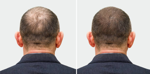 Hair transplant in Dubai