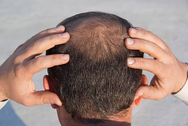 Does Hair Loss Treatment Reduce Hairline Thinning Issues