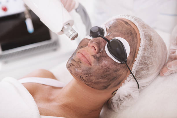 Does Laser Carbon Peel Improve Overall Facial Skin Appearance