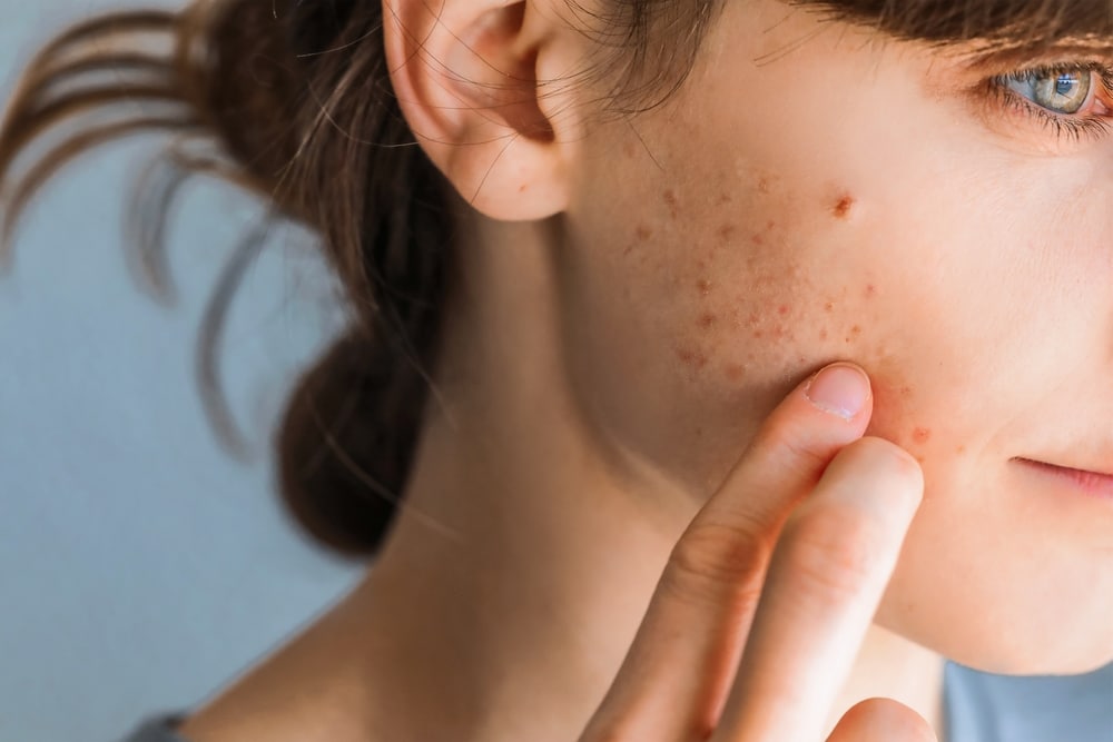 Acne Treatment Abu Dhabi