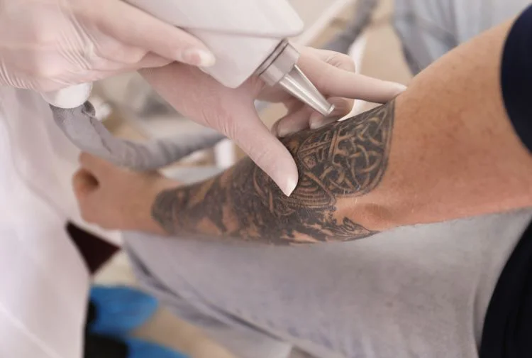 Picosure Tattoo Removal in Abu Dhabi