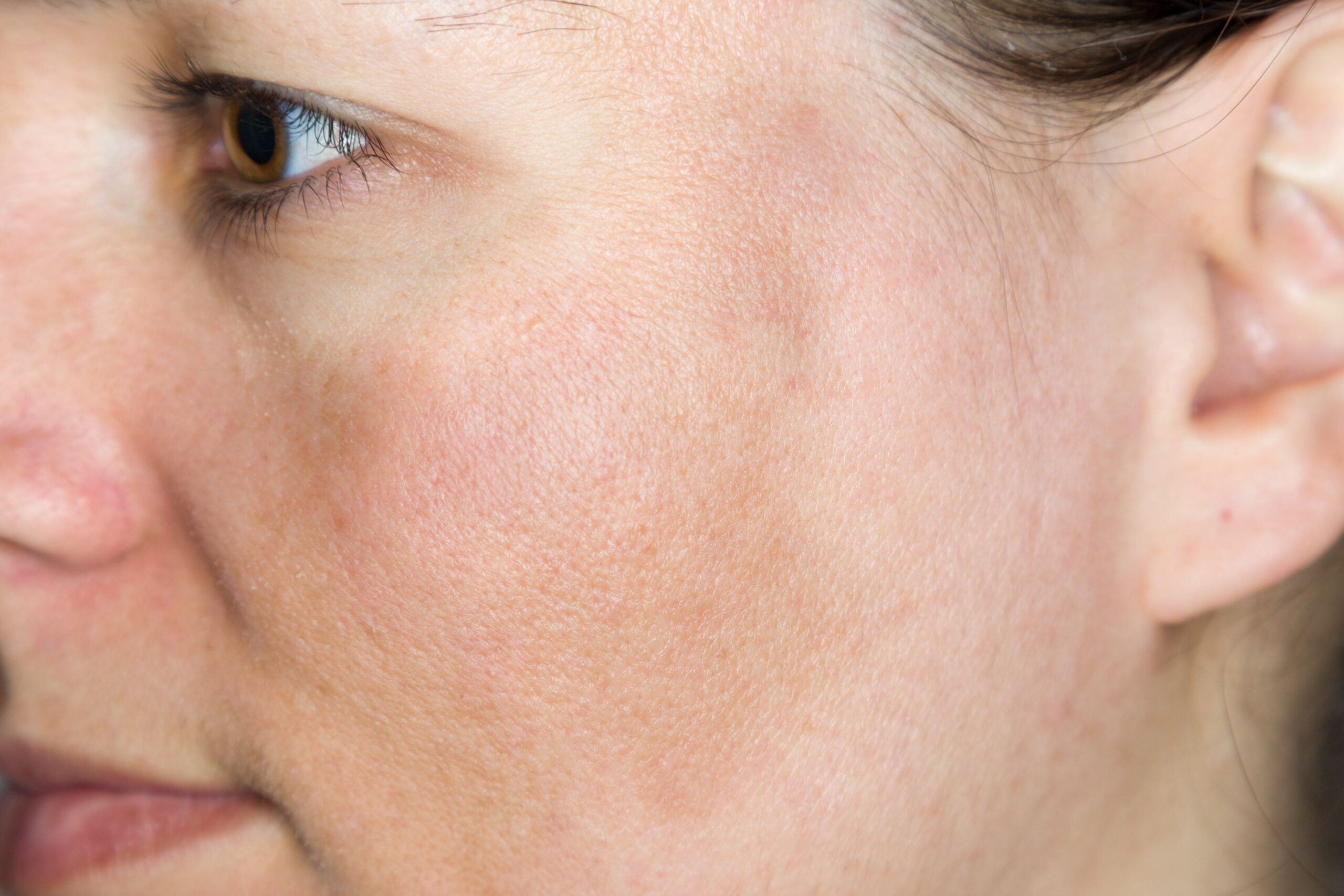 Pigmentation Treatment in Abu Dhabi