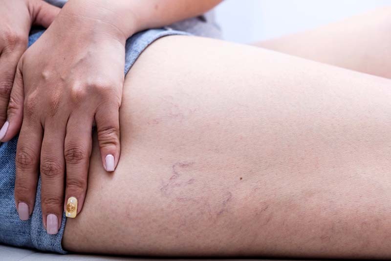 Sclerotherapy in Abu Dhabi
