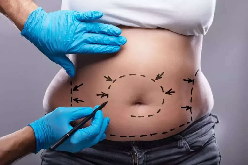 Tummy Tuck in Abu Dhabi