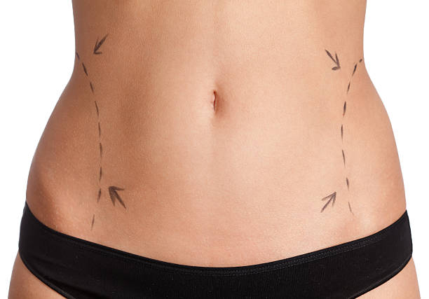 Is Liposuction Safe for Removing Fat From Multiple Areas