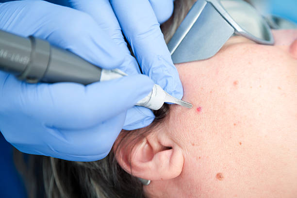 Is Mole Removal a Good Choice for Visible Facial Moles