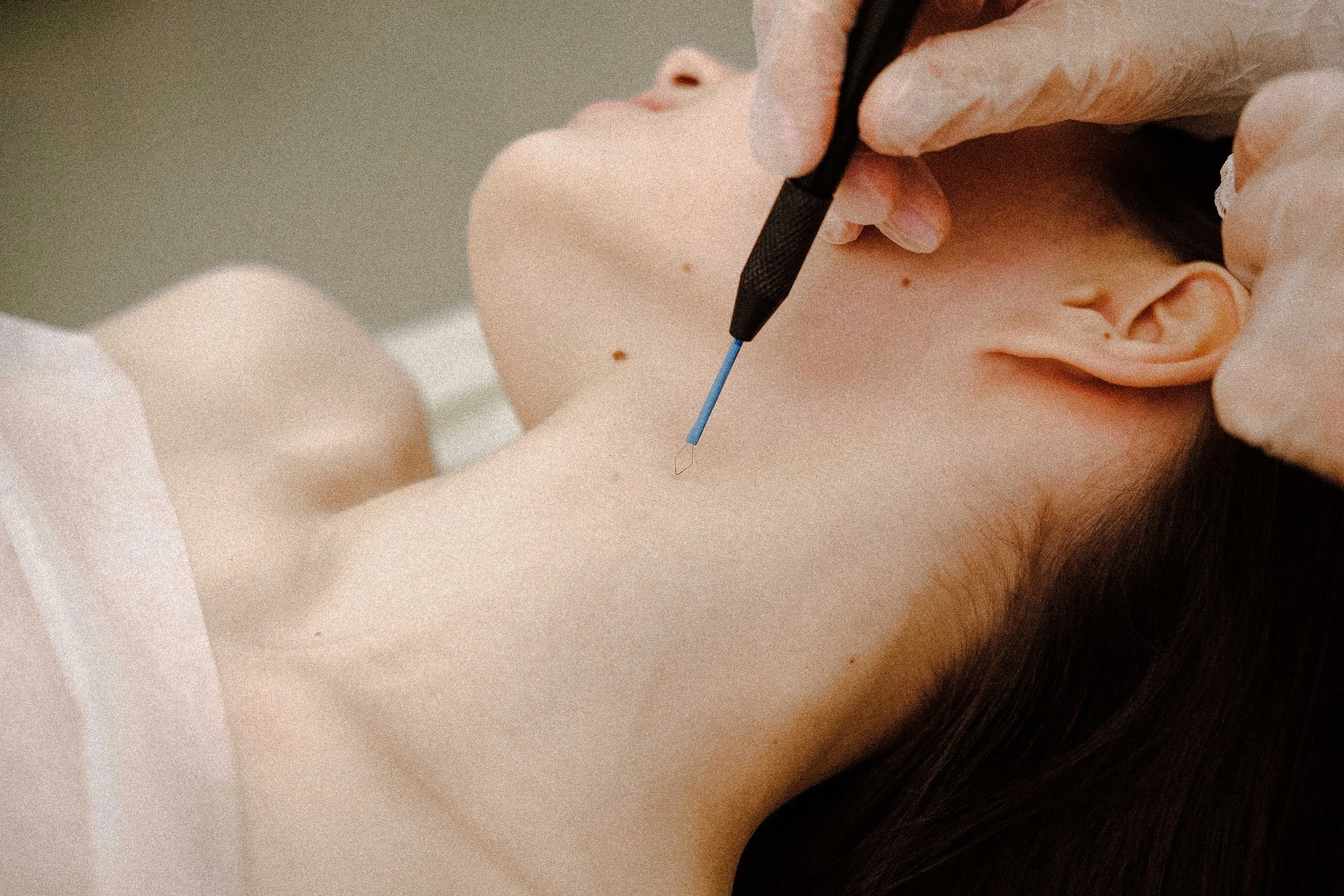 Skin Lesion Removal in Abu Dhabi