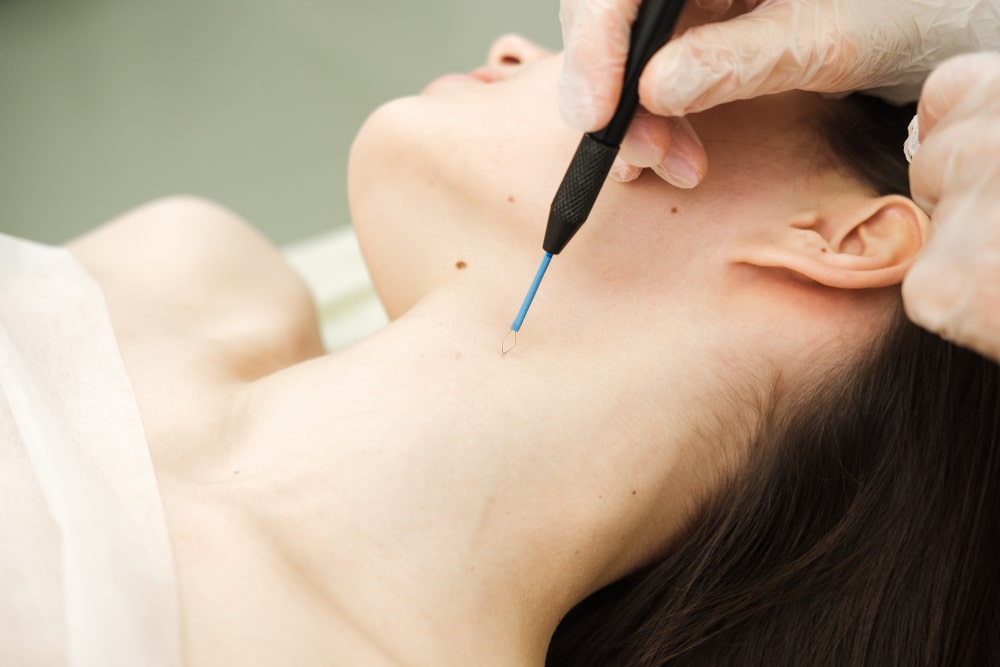 Warts Removal Treatment in Abu Dhabi