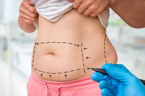 What Factors Affect Tummy Tuck Recovery and Final Results