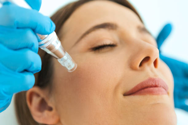 What RF Microneedling Treatments Help Tighten Facial Skin