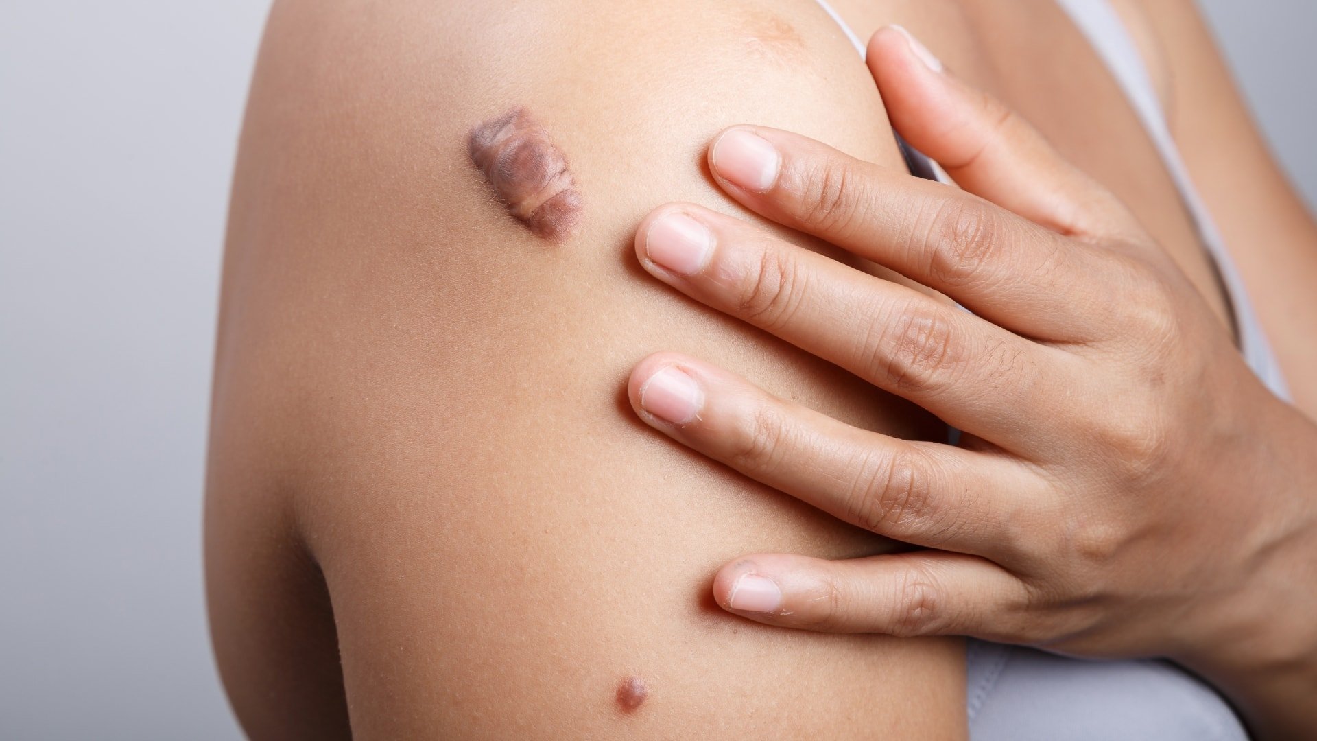 Keloid Treatment in Abu Dhabi