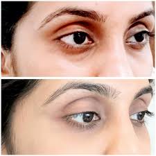 dermatologist treatment for dark circles