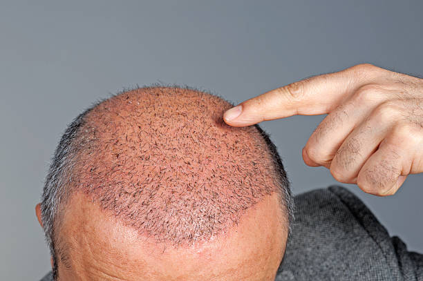 Can FUE Hair Transplant Restore Natural Hair Growth