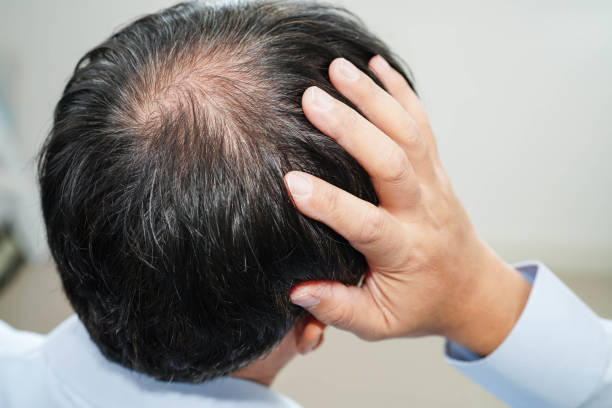 Can GFC Treatment for Hair Restore Hair Confidence