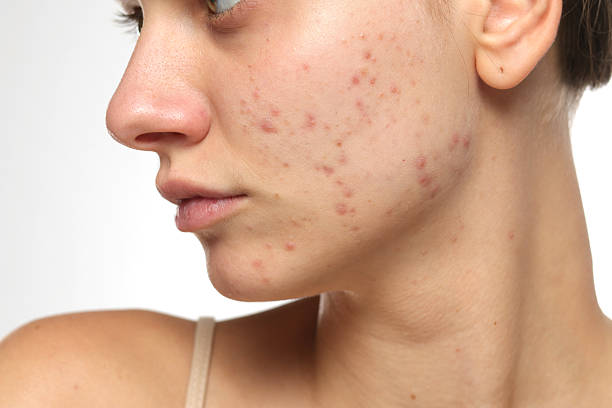 Can Laser Acne Scar Treatment Improve Skin Tone and Clarity
