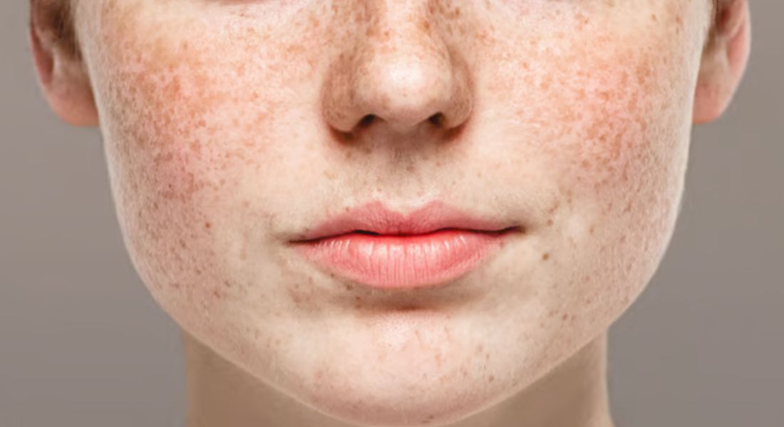 Can Melasma Treatment Reduce the Appearance of Brown Patches