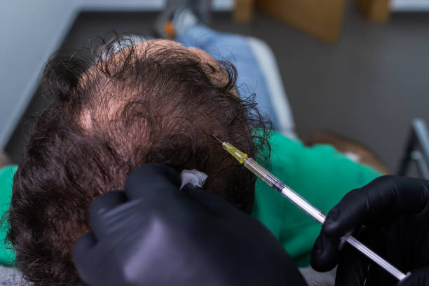 Can PRP Hair Treatment Improve Hair Growth in Men