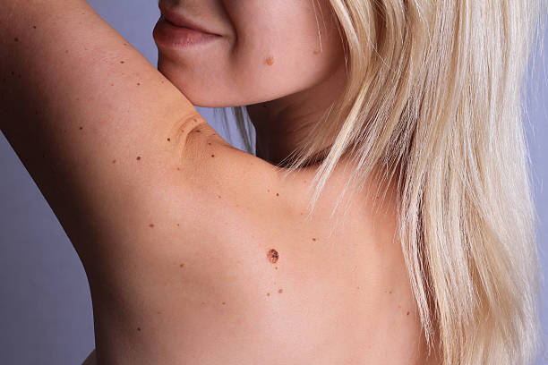 Can Skin Tag Removal Restore Smooth-Looking Skin