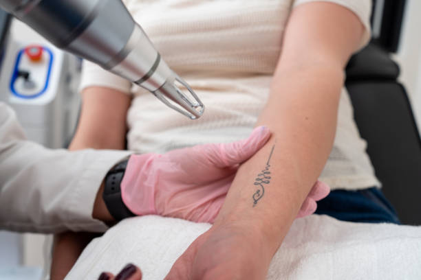 Can Tattoo Removal Remove Colored Ink Successfully