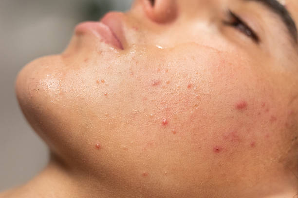 Does Acne Treatment Give Better Results Than Chemical Peel Therapy