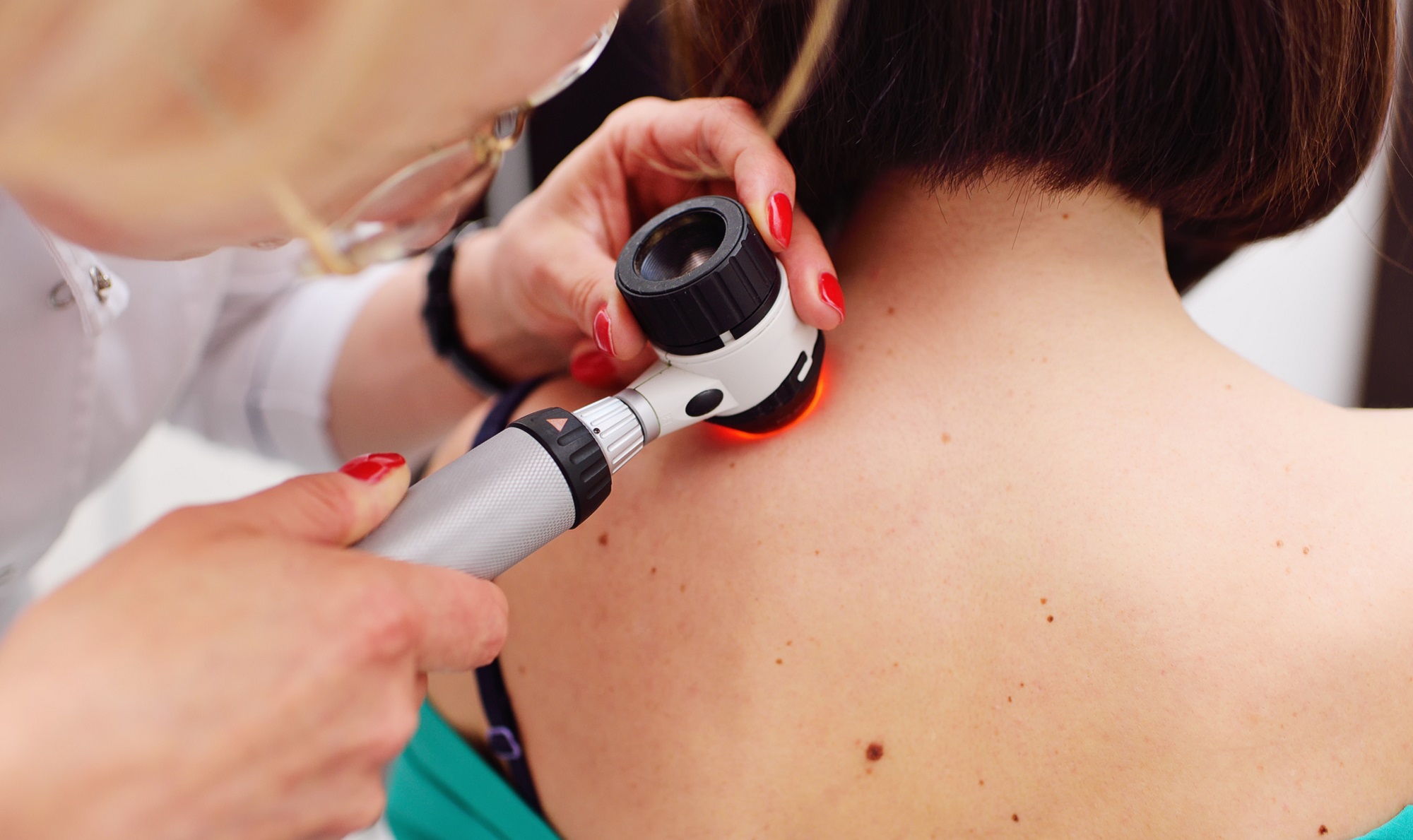 Dermoscopy Mole Evaluation in Abu Dhabi