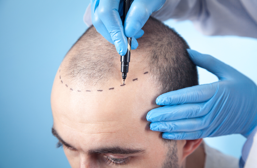 FUE Hair Transplant in Abu Dhabi