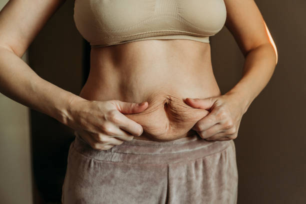 Does Mini Abdominoplasty Require a Long Downtime for Recovery