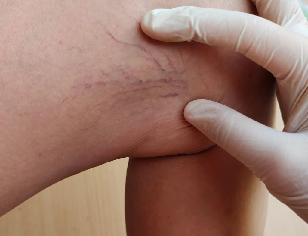 Spider Vein Treatment in Abu Dhabi