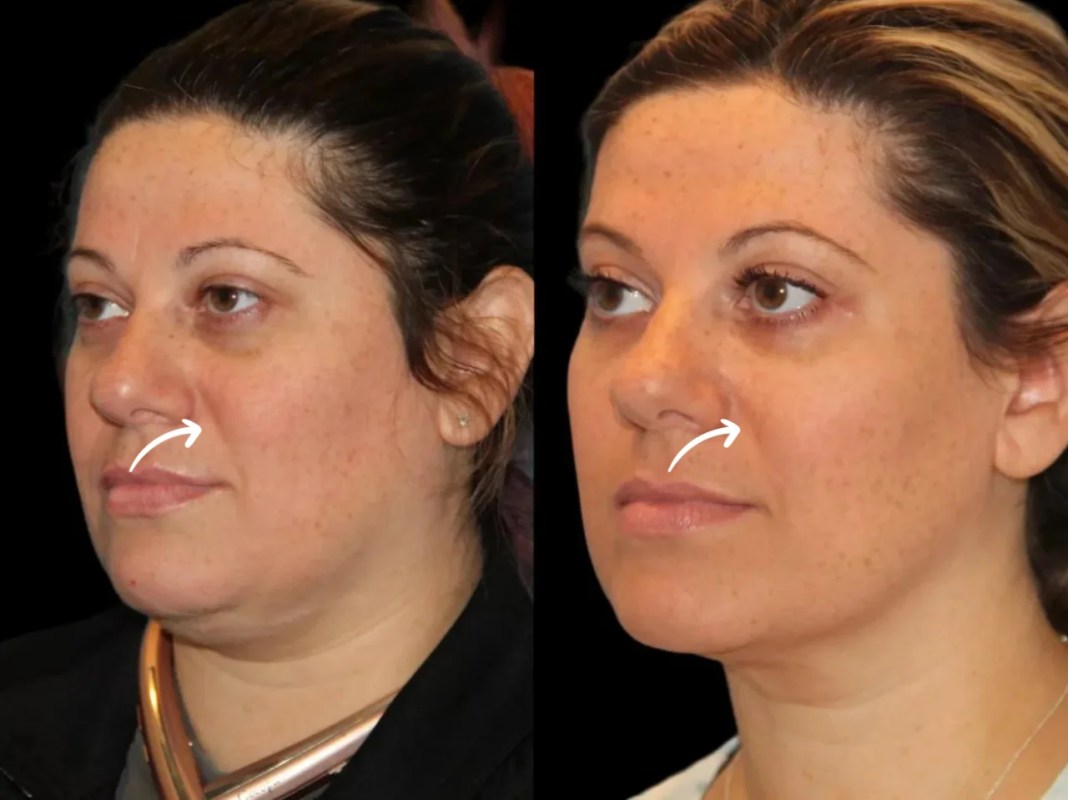 sculptra fillers i dubai
