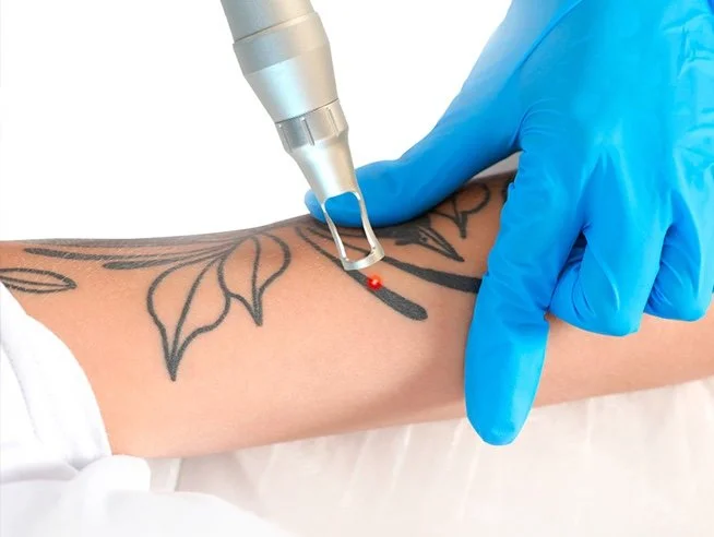 Laser Tattoo Removal Abu Dhabi