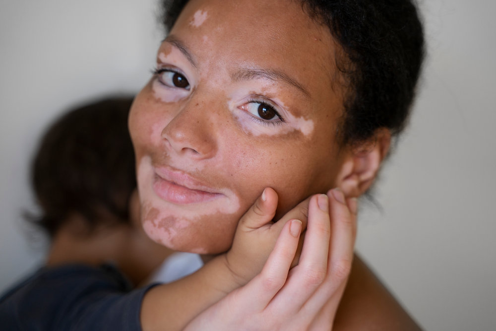 Vitiligo treatment in Abu Dhabi