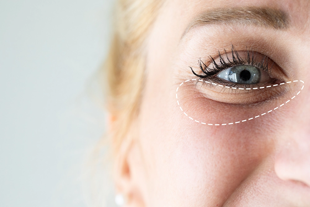 Eye Bag removal in Abu Dhabi