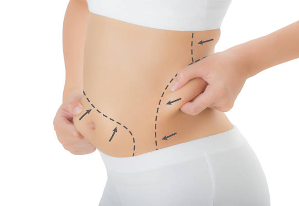 Is Laser Liposuction Effective for Flank Fat Reduction
