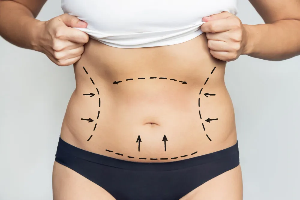 Liposuction Abu Dhabi