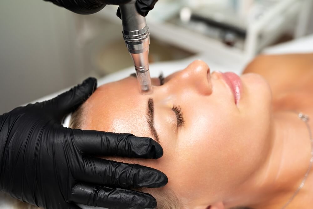 Microneedling for Acne Scars Abu Dhabi