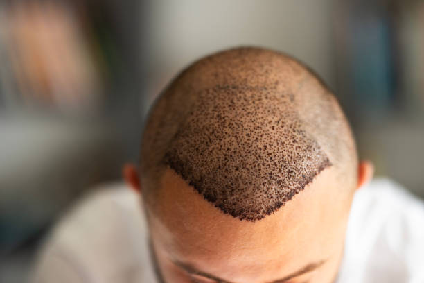 Is SMP Treatment the Best Solution for Thin Hairlines