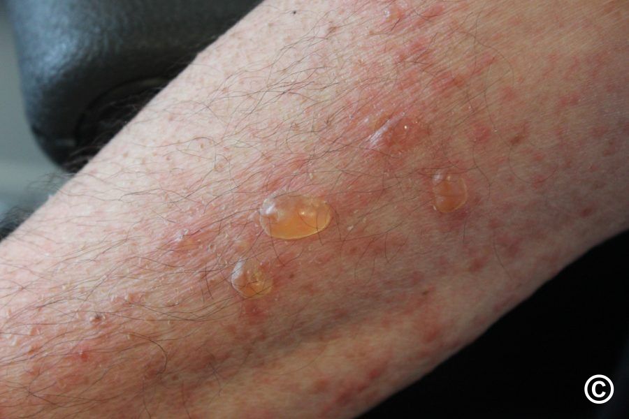 These Natural Remedies for Bullous Pemphigoid Will Help You Feel Better Fast