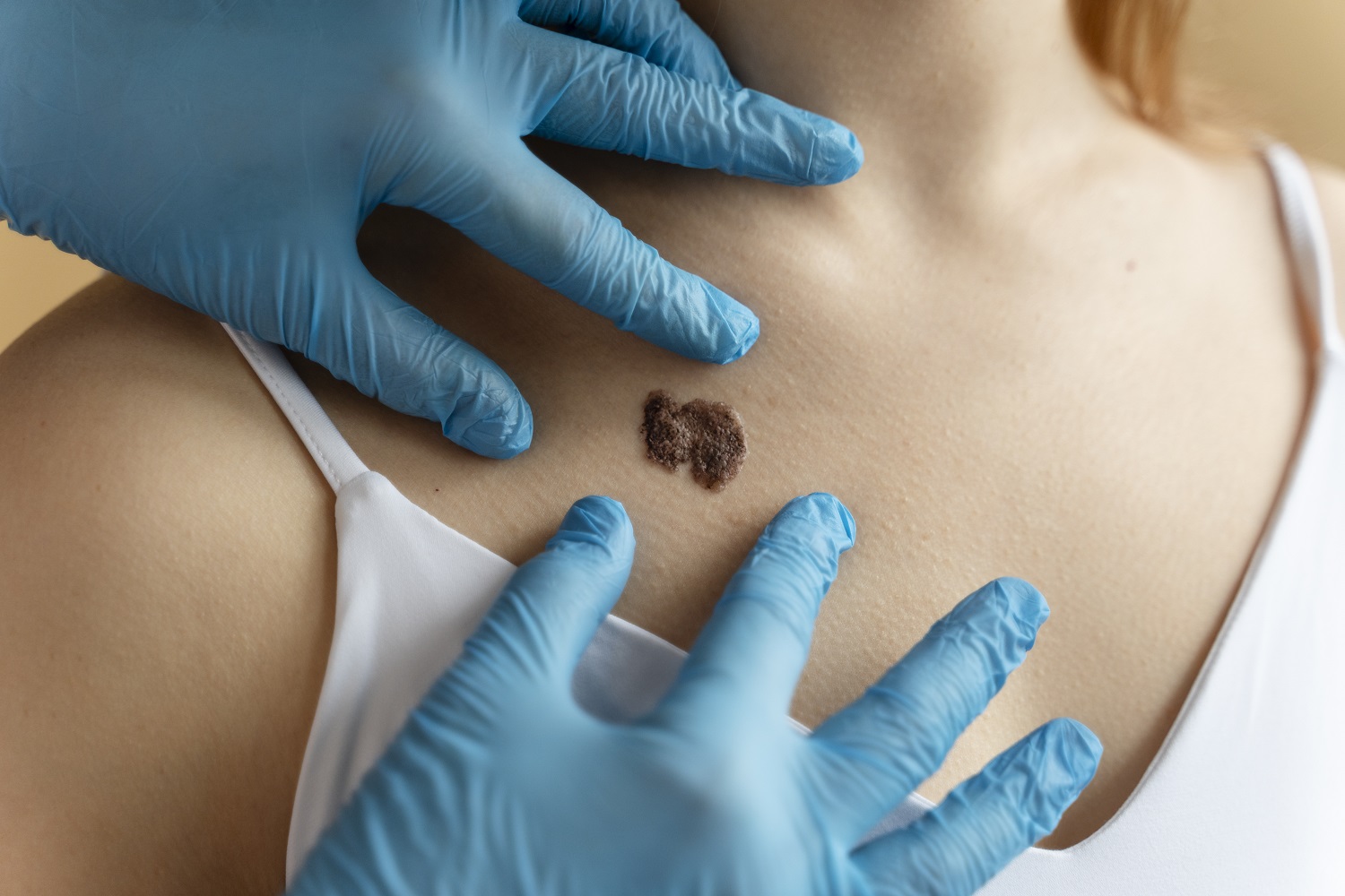Skin Tag Removal in Abu Dhabi
