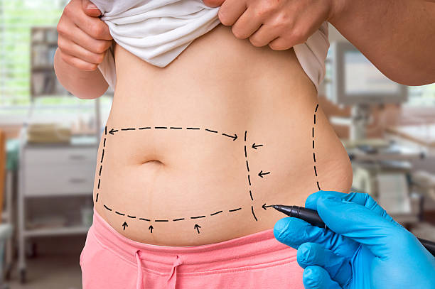 What Are the Long-Term Benefits of a Tummy Tuck