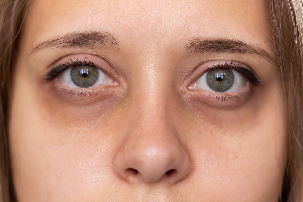 Dark Circles Treatment Abu Dhabi