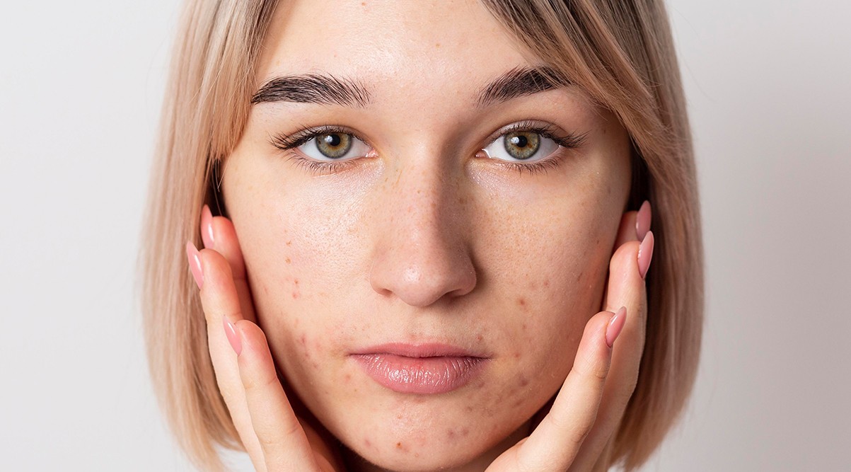 Laser Acne Scar treatment in Abu Dhabi