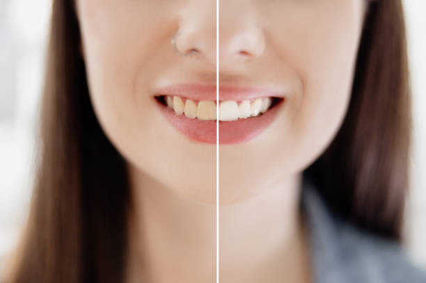 Teeth Whitening in Riyadh